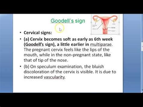 Obstetrics 096 c Goodell sign cervix soft pregnancy change how to know ...