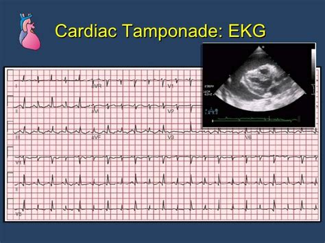 Pericardial Dse Cath Lab