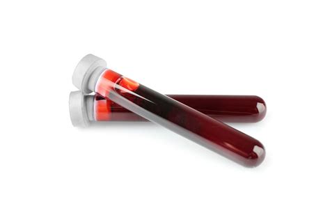 Phlebotomy, or Blood Removal, Found to Ease CEP Patient's Symptoms