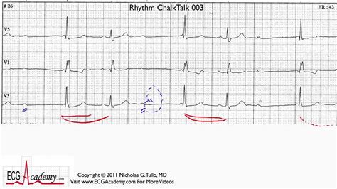 ECG Interpretation Tutorial - ChalkTalk 03 - Advanced Level - YouTube