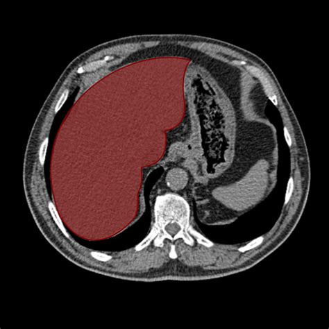 Can Ct Scan Detect Liver Cancer - CancerWalls