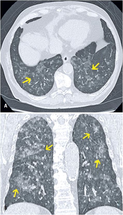 Differential diagnoses of acute ground-glass opacity in chest computed tomography: pictorial ...