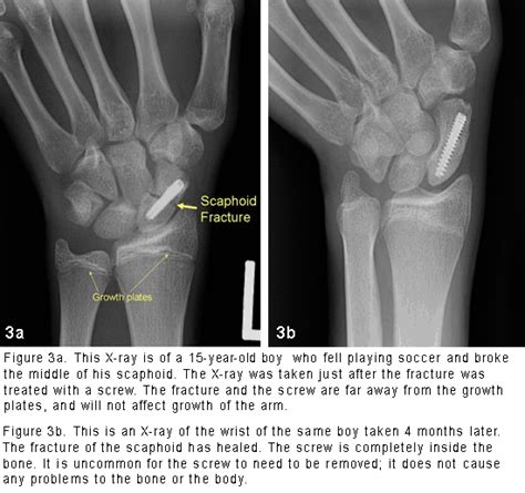 Scaphoid (Wrist Bone) Fracture - Orthopedic Specialists of Seattle