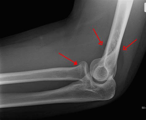 Radial Head Fractures - Clinical Features - Management - TeachMeSurgery