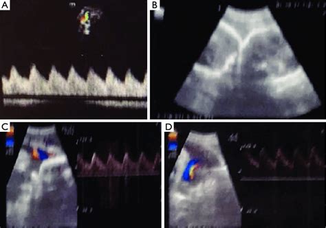 Ultrasound of 2 cases in the third trimester (A) On January 6 ...