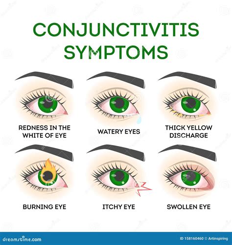 Conjunctivitis Symptoms. Pink Eye Disease, Infection and Allergy Stock Vector - Illustration of ...