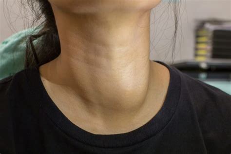 If You Have Bumps on Your Neck, Here's What It Could Mean | Reader's Digest