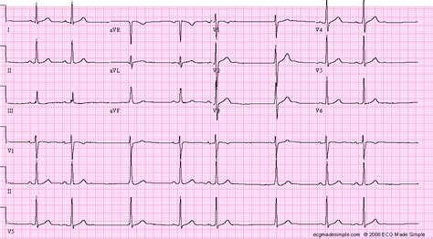 Case 127: A 43-Year-Old Woman with Presyncope - ECG Made Simple