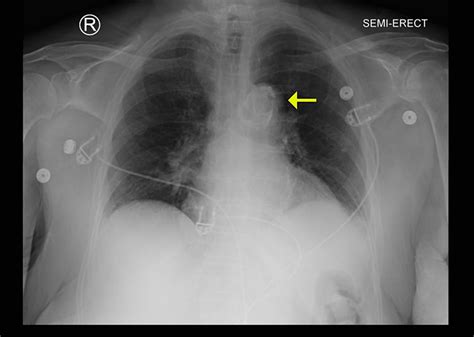 Cureus | Unidentified Object in the Mediastinum: A Case Report of ...