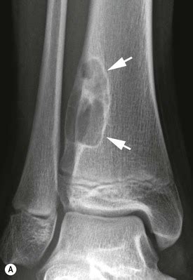 Bone Tumours (1) | Radiology Key