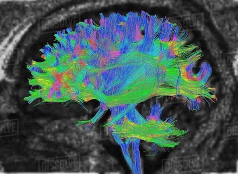 Diffusion MRI, also referred to as diffusion tensor imaging or DTI, of the human brain - Stock ...