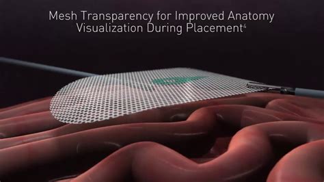 Symbotex™ Composite Mesh For Ventral Hernia Repair Animation - YouTube