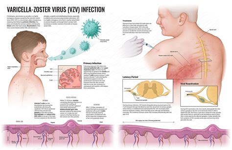 Herpes Zoster Virus Structure