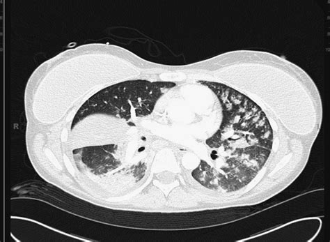 A CT scan of the chest revealed a marked dense consolidation of the... | Download Scientific Diagram