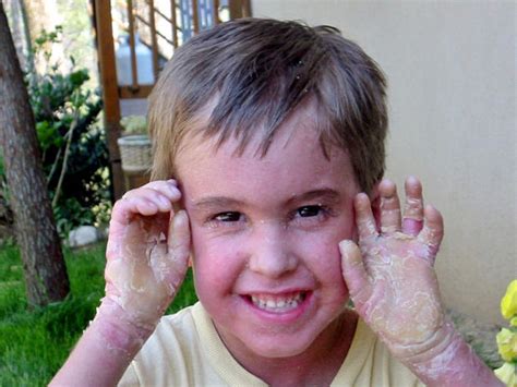 Epidermolytic ichthyosis - 9 uncommon skin conditions - Pictures - CBS News