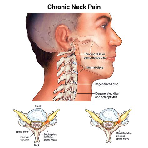 Why Chronic Neck Pain Should Never Be Ignored - NJ's Top Orthopedic Spine & Pain Management Center