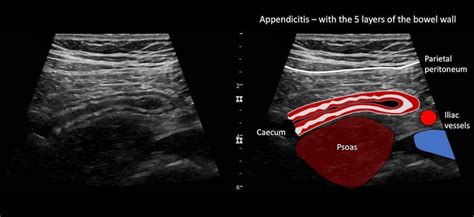 Appendix Ultrasound Normal Measurements