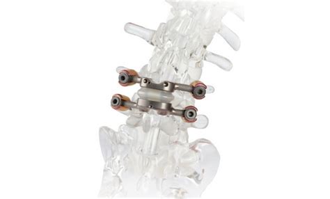 Premia Spine TOPS™ System Achieves FDA Premarket Approval with Superiority-to-Fusion Label ...