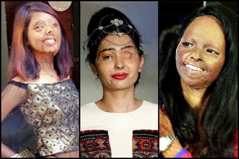 7 acid attack survivors who did not let their scars dampen their spirits