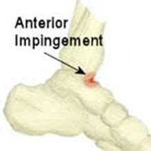 Ankle Impingement - Symptoms, Causes, Treatment & Rehabilitation