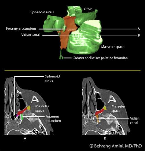 Fossa pterygopalatina | pacs