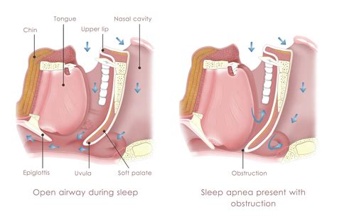 What Are The Different Kinds of Sleep Apnea Appliances? - Newbury ...