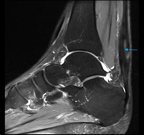 MRI Achilles Tendon - Melbourne Radiology