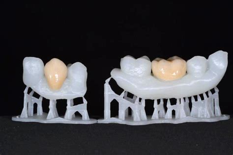 3D Printed Teeth on the Form 1+ Help Dentists and Patients Prepare for ...