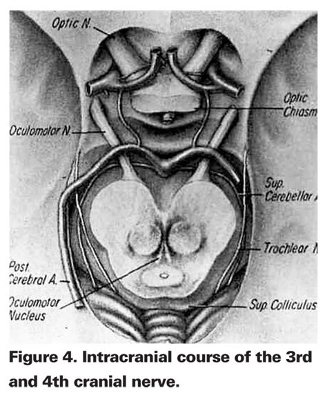 Trochlear Nerve Mri