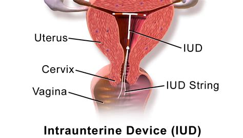 Mirena IUD Lawsuits | Injury Claims & Legal Information