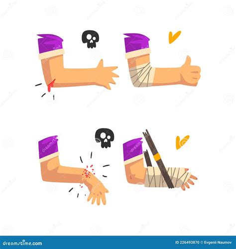 First Aid for Wounded Bloody Elbow and Arm Fracture Vector Set Stock ...