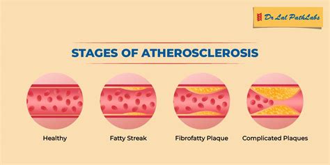 Atherosclerosis: Symptoms & Diagnosis - Dr Lal PathLabs Blog