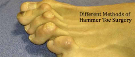 Different Methods Of Hammer Toe Surgery: LondonFootandAnkleSurgery.co.uk