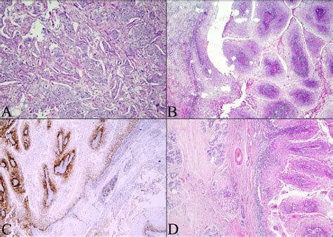 The histopathological findings of the tumor on mastectomy specimen. (A)... | Download Scientific ...