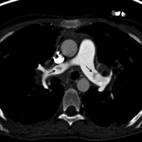 (left): 29 year old female with systemic to pulmonary artery shunt in... | Download Scientific ...