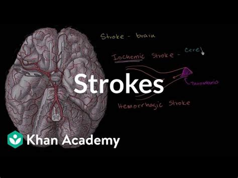 The Bamford Classification of Stroke