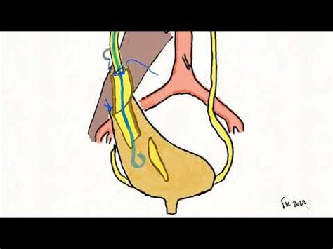 Boari flap and psoas hitch for treatment of long ureteral stenosis - animation - YouTube