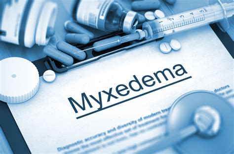 Symptoms and Causes of Myxedema - Facty Health