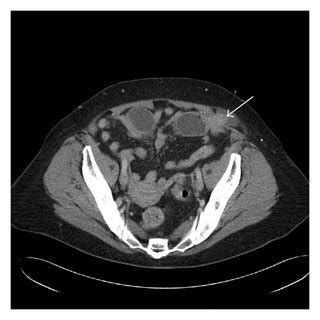 (PDF) Emergent Laparoscopic Repair of a Spigelian Hernia: Case Report and Review of the Literature