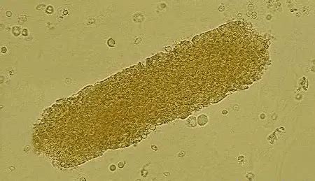 Types Of Casts Found In Urine And Their Clinical Significance - Laboratoryinfo.com