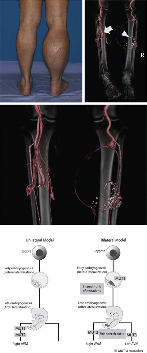 Arteriovenous Malformation Leg