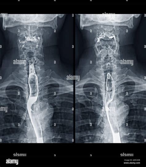 Barium Swallow study test diagnose Barrett's GI tract exam GERD ulcers series difficulty pharynx ...