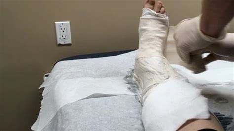 Broken ankle cast by doctor plaster band... | Stock Video | Pond5