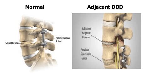 Adjacent Level Degeneration - Excel Spine