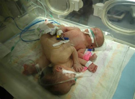 Doctors Successfully Separate Baby Boy From His Parasitic Twin In ...