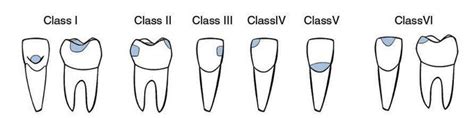 GV Black Classification of Caries - MEDizzy