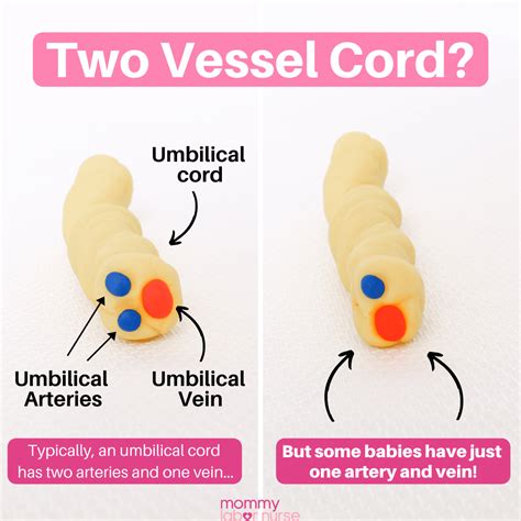 Anatomy Of Umbilical Cord Two Umbilical Arteries And One Umbilical ...