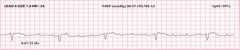 3rd Degree AV Block (Complete Heart Block) #Clinical ... | GrepMed