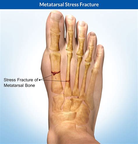 Metatarsal Bone Fracture