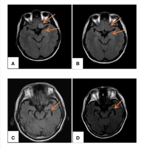 | MRI findings. (A) MRI FLAIR/T2 of case 4 displaying abnormal signals... | Download Scientific ...